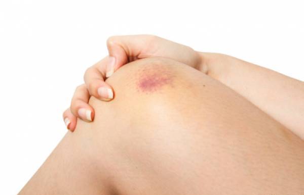 11 cách chữa lành vết bầm tím hiệu quả tại nhà 7