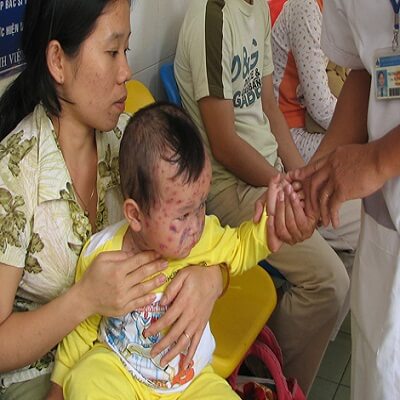 4 bệnh dễ tấn công trẻ sau kỳ nghỉ Tết 34 4 bệnh dễ tấn công trẻ sau kỳ nghỉ Tết 6