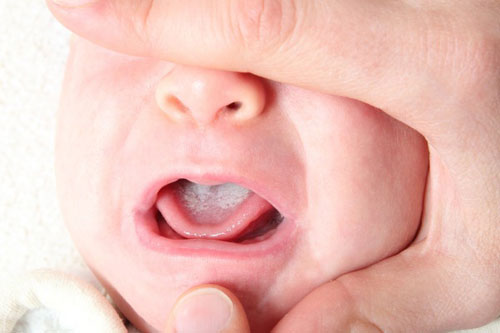4 bước để rơ lưỡi bằng lá hẹ cho trẻ sơ sinh tại nhà 35 rơ lưỡi cho trẻ