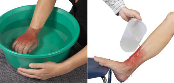 4 bước đơn giản để không bị sẹo khi bỏng bô 35 4 bước đơn giản để không bị sẹo khi bỏng bô 7