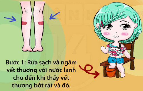 4 bước đơn giản giúp bạn ngừa sẹo khi bị bỏng pô xe máy 35 4 bước đơn giản giúp bạn ngừa sẹo khi bị bỏng pô xe máy 7
