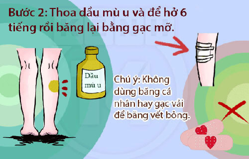 4 bước đơn giản giúp bạn ngừa sẹo khi bị bỏng pô xe máy 37 4 bước đơn giản giúp bạn ngừa sẹo khi bị bỏng pô xe máy 9