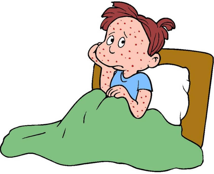 4 sai lầm nguy hiểm khi chăm con bị thủy đậu 36 4 sai lầm nguy hiểm khi chăm con bị thủy đậu 8