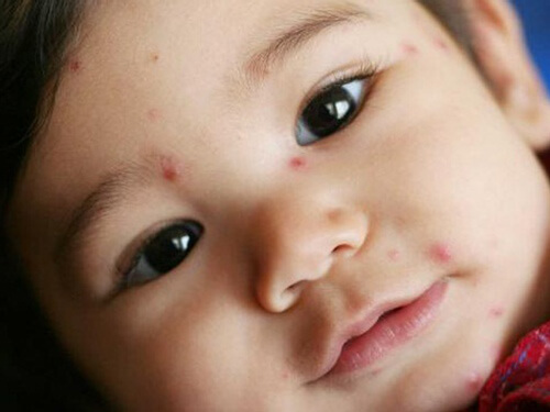 4 sai lầm nguy hiểm khi chăm con bị thủy đậu 37 4 sai lầm nguy hiểm khi chăm con bị thủy đậu 9