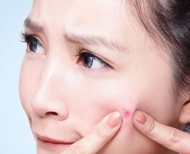 5 bước nặn mụn đúng cách không để lại sẹo và vết thâm 8