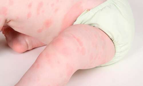 5 cách phòng ngừa dị ứng thức ăn ở trẻ 37 5 cách phòng ngừa dị ứng thức ăn ở trẻ 9