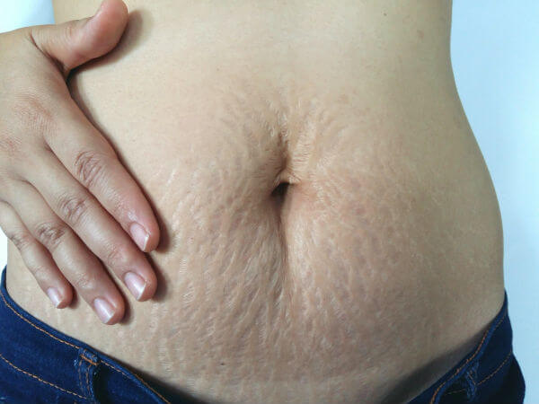 8 bí quyết khắc phục làn da chảy xệ sau sinh 8