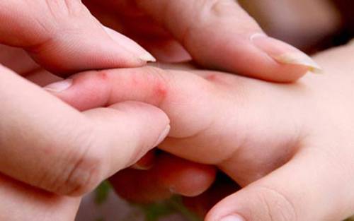 8 điều có thể bạn chưa biết về bệnh tay chân miệng 37 8 điều có thể bạn chưa biết về bệnh tay chân miệng 9