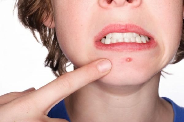 Bạn đã biết 10 công dụng tuyệt vời này của aspirin chưa? 42 Bạn đã biết 10 công dụng tuyệt vời này của aspirin chưa? 14