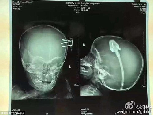 Bé 2 tuổi bị phích điện cắm vào đầu do ngã từ trên giường xuống 34 Bé 2 tuổi bị phích điện cắm vào đầu do ngã từ trên giường xuống 6