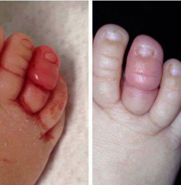 Bé bị hoại tử ngón chân chỉ vì sợi tóc rụng của mẹ 9