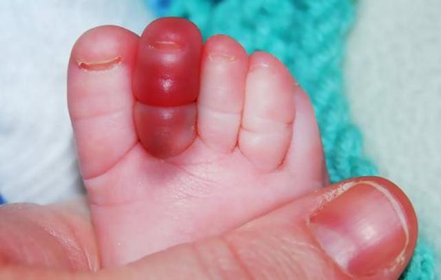Bé bị hoại tử ngón chân chỉ vì sợi tóc rụng của mẹ 10