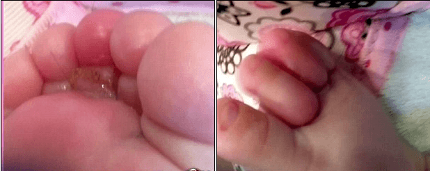 Bé bị hoại tử ngón chân chỉ vì sợi tóc rụng của mẹ 12