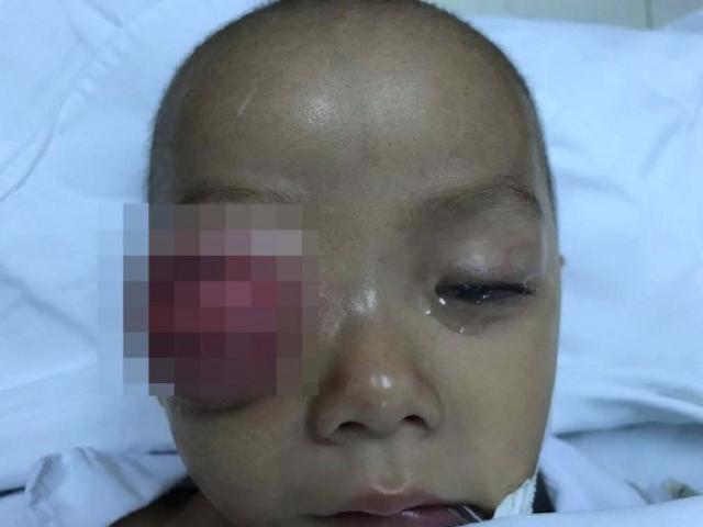 Bé trai 16 tháng tuổi suýt bị mù mắt do biến chứng viêm xoang 33 Bé trai 16 tháng tuổi suýt bị mù mắt do biến chứng viêm xoang 5