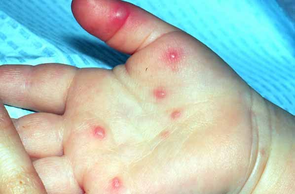 Bệnh tay chân miệng có nguy cơ bùng phát mùa tựu trường 34 Bệnh tay chân miệng có nguy cơ bùng phát mùa tựu trường 6