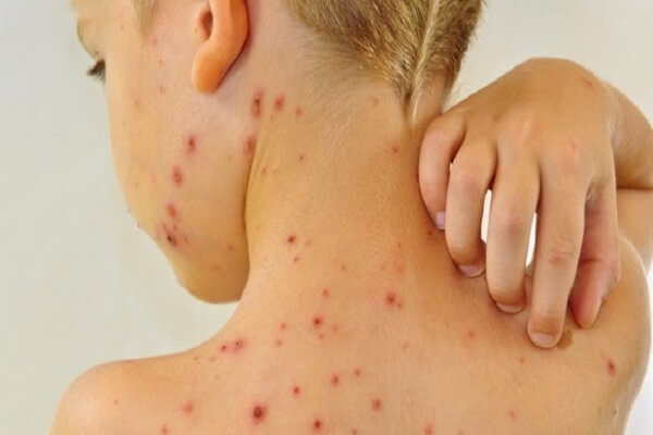 Các bệnh về da thường gặp vào hè và cách phòng tránh 35 Các virut gây ra bệnh về da