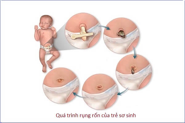 Các bước vệ sinh và chăm sóc dây rốn bé yêu đúng cách 7