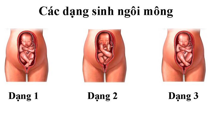 Các kiểu ngôi thai mẹ bầu nào cũng nên biết 36 ngoi-mong