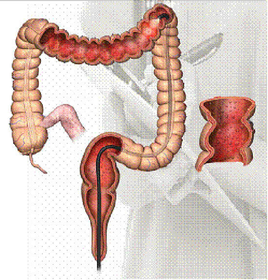 Các yếu tố gia đình có nguy cơ gây ra 20% ung thư đại trực tràng 37 cac-yeu-to-gia-dinh-co-nguy-co-gay-ra-20-ung-thu-dai-truc-trang