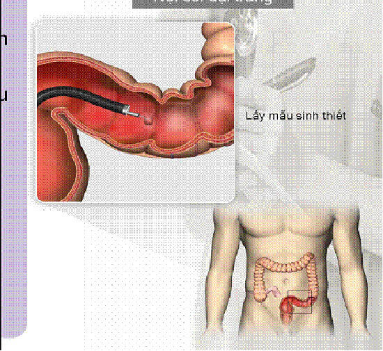Các yếu tố gia đình có nguy cơ gây ra 20% ung thư đại trực tràng 39 cac-yeu-to-gia-dinh-co-nguy-co-gay-ra-20-ung-thu-dai-truc-trang