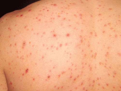 Cách phòng ngừa bệnh thủy đậu 34 cach-phong-ngua-benh-thuy-dau