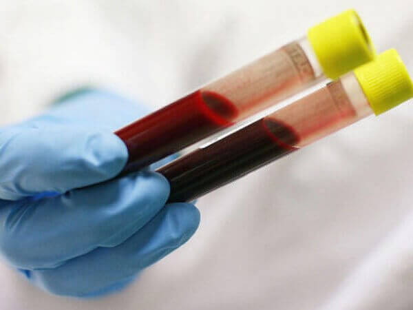 Cẩn trọng Thalassemia - căn bệnh di truyền sang trẻ 38 can-trong-thalassemia-can-benh-di-truyen-sang-tre