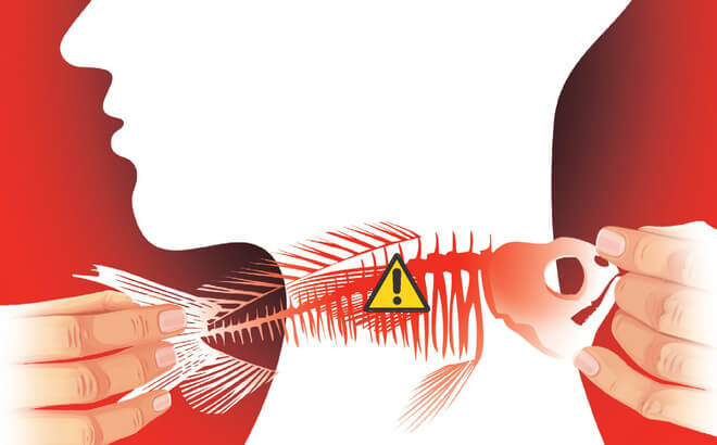 Chẳng may bị hóc xương cá, hãy áp dụng ngay những cách đơn giản và hiệu quả sau 35 Chẳng may bị hóc xương cá, hãy áp dụng ngay những cách đơn giản và hiệu quả sau 7