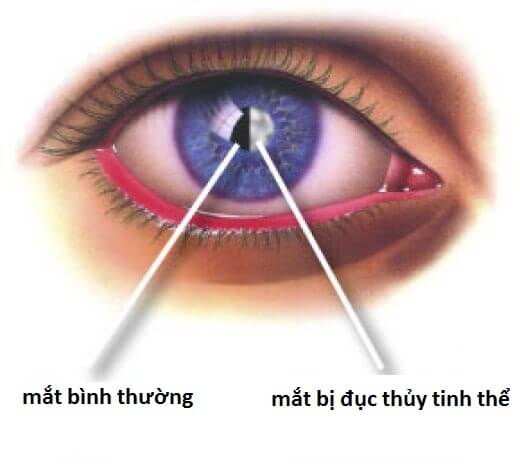 Chữa đục thủy tinh thể bằng rau mùi tây, bạn đã biết chưa? 34 Chữa đục thủy tinh thể bằng rau mùi tây, bạn đã biết chưa? 6