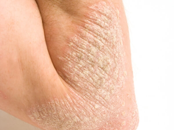 Chữa dứt điểm vảy nến bằng lá trầu và bèo hoa dâu 10