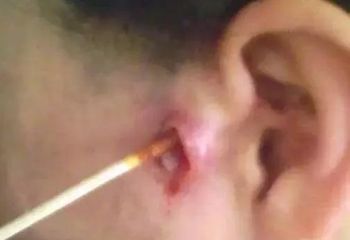Có phải trẻ sinh ra với lỗ nhỏ trên vành tai sẽ thông minh xuất chúng? 35 Có phải trẻ sinh ra với lỗ nhỏ trên vành tai sẽ thông minh xuất chúng? 7