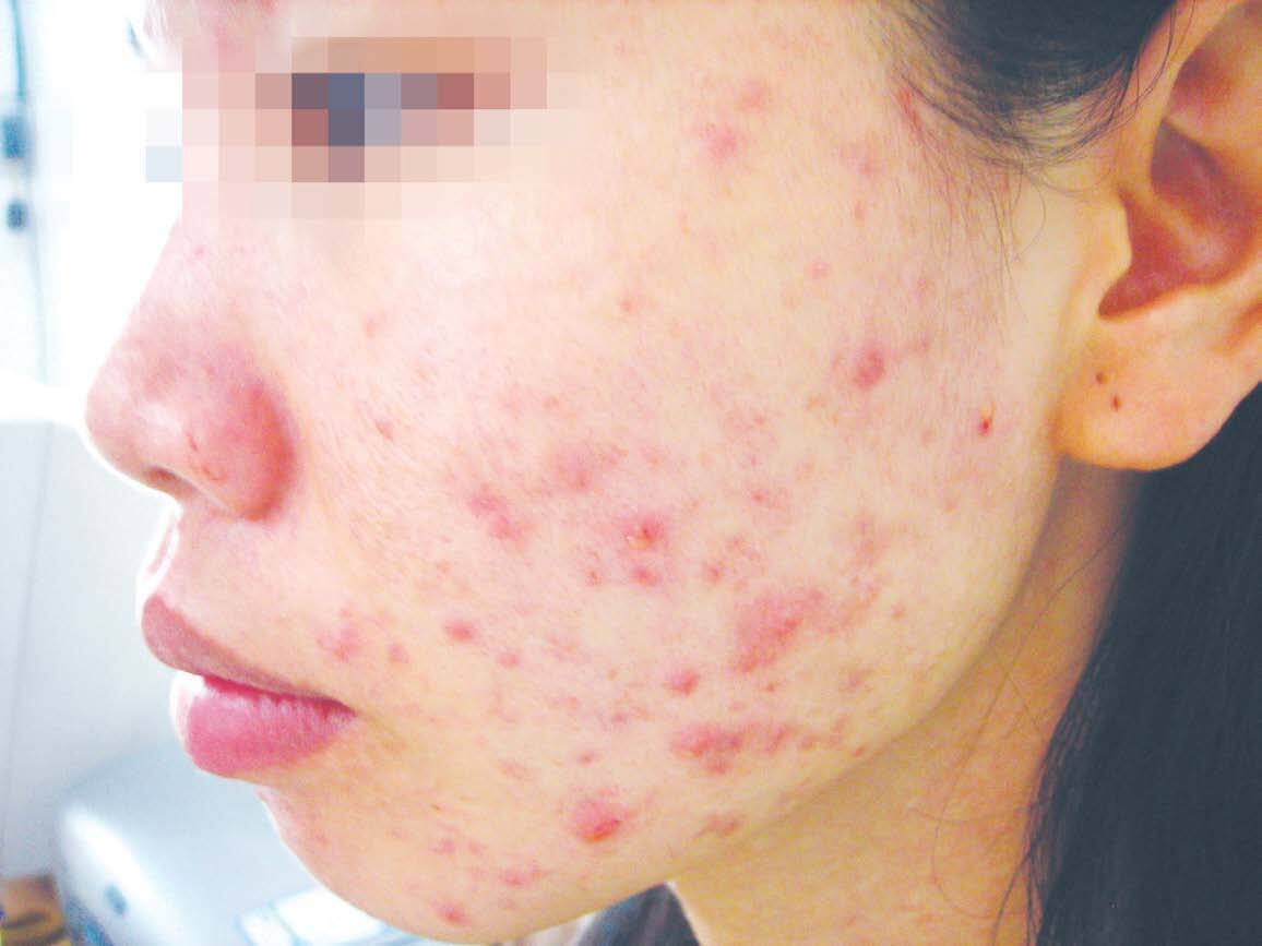Cứu nguy cho làn da bị dị ứng mỹ phẩm 35 noi-mun