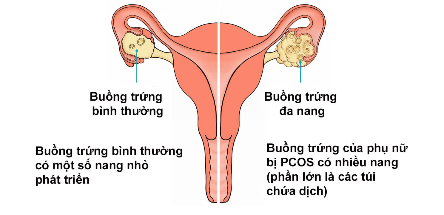 Đa nang buồng trứng, nguyên nhân hàng đầu dẫn đến vô sinh 35 Đa nang buồng trứng, nguyên nhân hàng đầu dẫn đến vô sinh 7