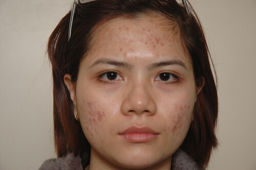 Đẹp da, sạch mụn toàn thân chỉ với một nắm lá tía tô trong vườn 34 Đẹp da, sạch mụn toàn thân chỉ với một nắm lá tía tô trong vườn 6