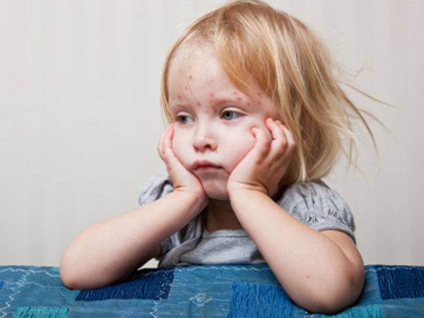 Dị ứng nổi mề đay: không phải là “chuyện nhỏ” 8