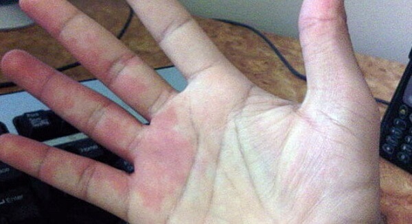 Đoán tình trạng sức khỏe qua bộc lộ của bàn tay 35 tay-ngua