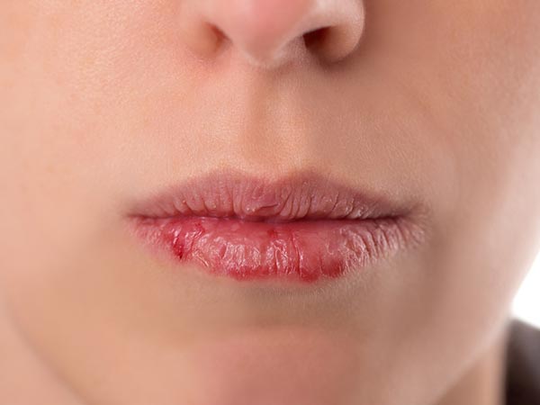 Đôi môi và những dấu hiệu cảnh báo sức khỏe 41 Đôi môi và những dấu hiệu cảnh báo sức khỏe 13