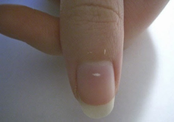 Đốm trắng trên móng tay báo hiệu điều gì? 35 Đốm trắng trên móng tay báo hiệu điều gì? 7