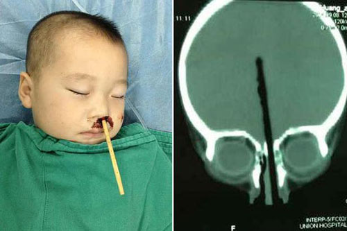 Đũa ăn cơm, hung thần của trẻ nhỏ 40 Đũa ăn cơm, hung thần của trẻ nhỏ 12