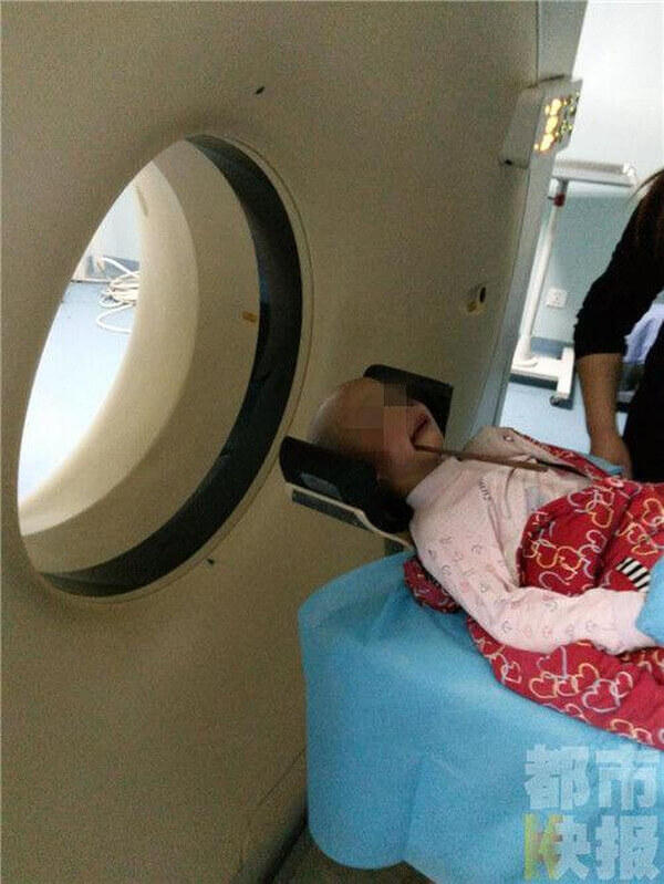 Đũa ăn cơm, hung thần của trẻ nhỏ 46 Đũa ăn cơm, hung thần của trẻ nhỏ 18