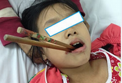 Đũa ăn cơm, hung thần của trẻ nhỏ 47 Đũa ăn cơm, hung thần của trẻ nhỏ 19