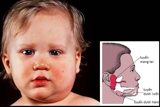 Đừng lơ là dấu hiệu sớm cảnh báo ung thư ở trẻ nhỏ 8