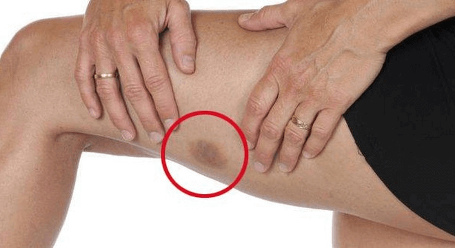 Đừng lơ là với những vết bầm tím trên người con trẻ 9