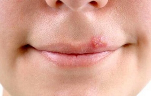 Đuổi mụn rộp ở môi rất dễ bằng nguyên liệu sẵn có 8
