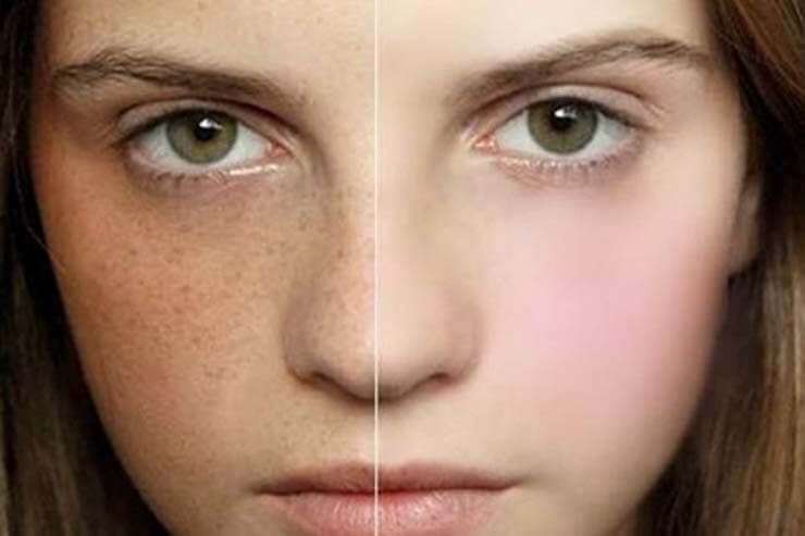 Giảm sạm, tàn nhang nhờ sữa và khoai tây 33 Giảm sạm, tàn nhang nhờ sữa và khoai tây