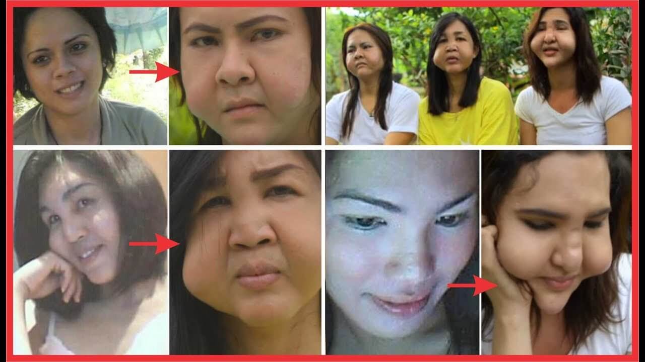 Ham thẩm mỹ giá rẻ, 3 cô gái đau khổ vì khuôn mặt biến dạng 7