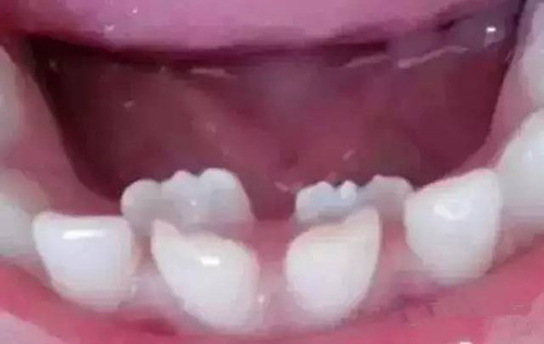 Hoảng hốt với cậu bé mọc cùng lúc 3 hàm răng 33 Hoảng hốt với cậu bé mọc cùng lúc 3 hàm răng 5