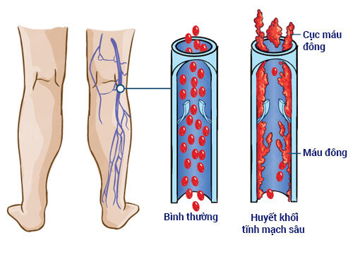 Huyết khối tĩnh mạch khi mang thai nguy hiểm như thế nào? 35 Huyết khối tĩnh mạch khi mang thai nguy hiểm như thế nào? 7