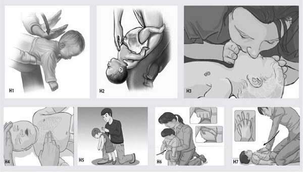 Kỹ thuật sơ cứu nghẹt thở do dị vật đường hô hấp ở trẻ nhỏ 36 Kỹ thuật sơ cứu nghẹt thở do dị vật đường hô hấp ở trẻ nhỏ 8