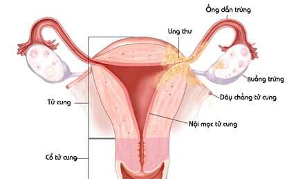 lạc nội mạc tử cung