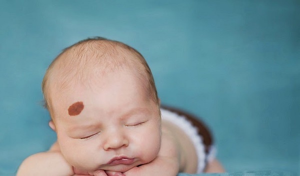 Mẹo dân gian giúp mẹ "xóa sổ" nhanh vết bớt, chàm trên da bé yêu 33 Mẹo dân gian giúp mẹ "xóa sổ" nhanh vết bớt, chàm trên da bé yêu 5